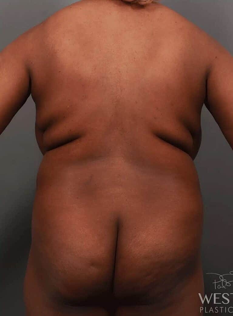 Breast Reduction Before & After