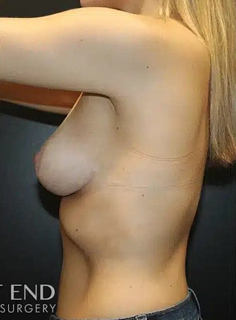 Breast Reduction Before & After
