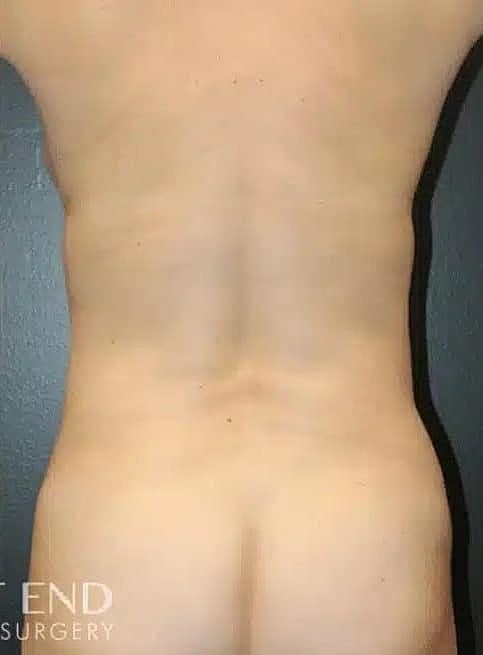 Breast Reduction Before & After