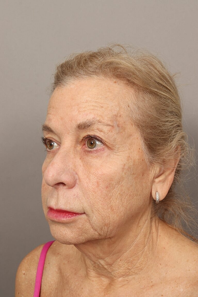 Lip Lift Before & After