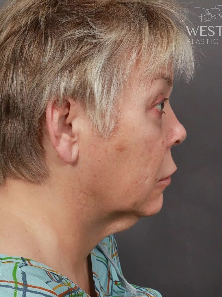 Lip Lift Before & After
