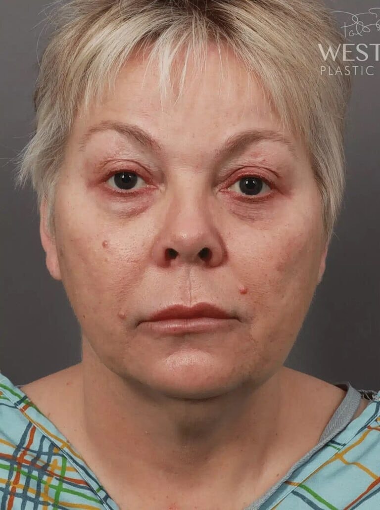 Lip Lift Before & After