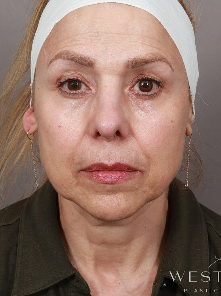 Lip Lift Before & After