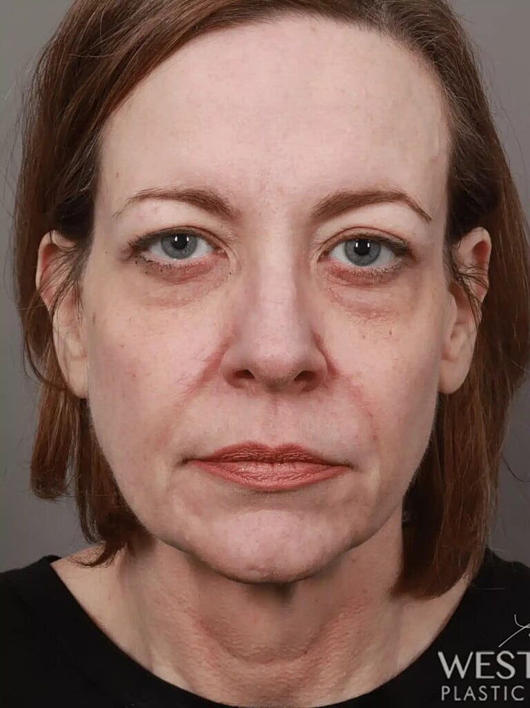 Lip Lift Before & After