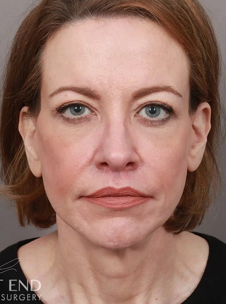 Lip Lift Before & After