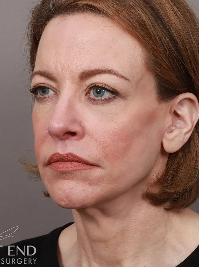 Lip Lift Before & After
