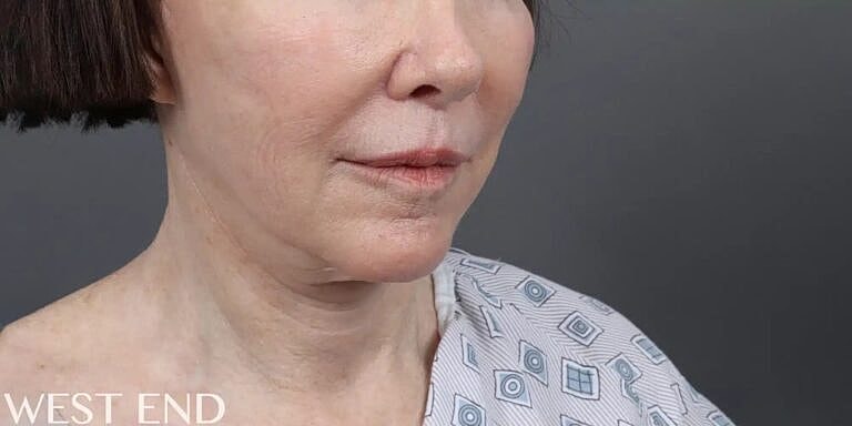 Lip Lift Before & After