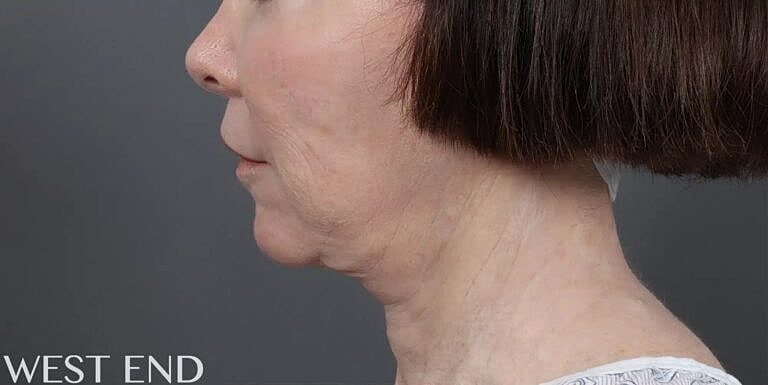 Lip Lift Before & After