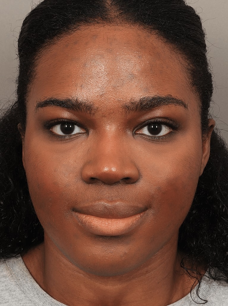 Brow Lift Before & After