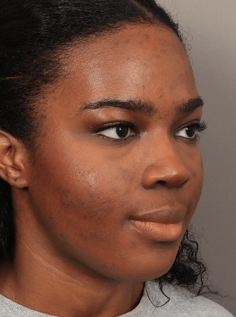 Brow Lift Before & After