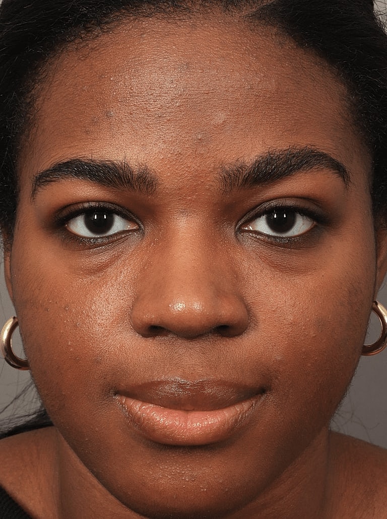 Brow Lift Before & After