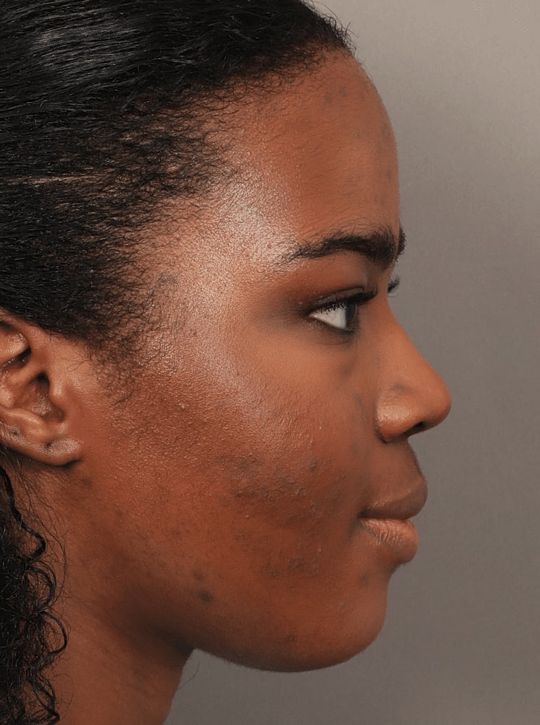 Brow Lift Before & After