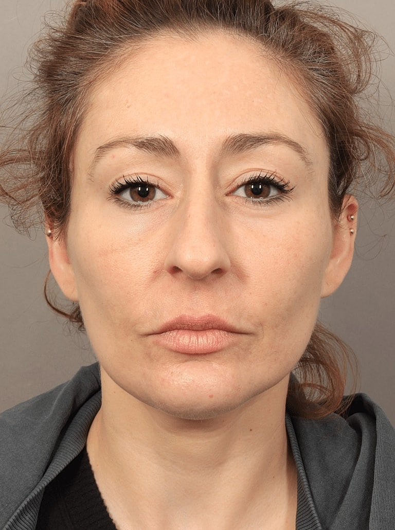 Brow Lift Before & After