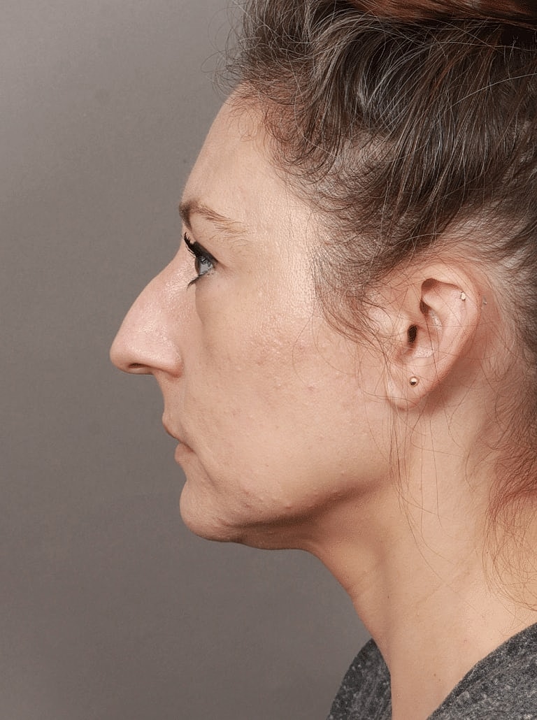 Brow Lift Before & After