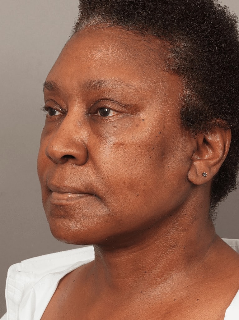 Brow Lift Before & After
