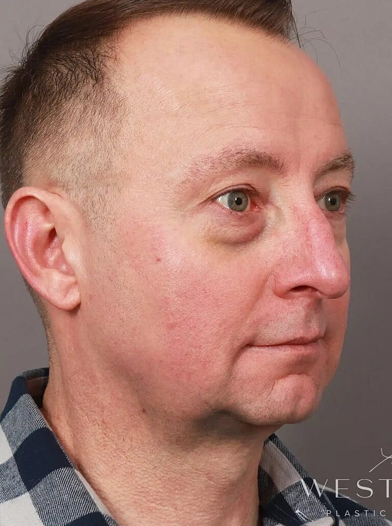 Brow Lift Before & After