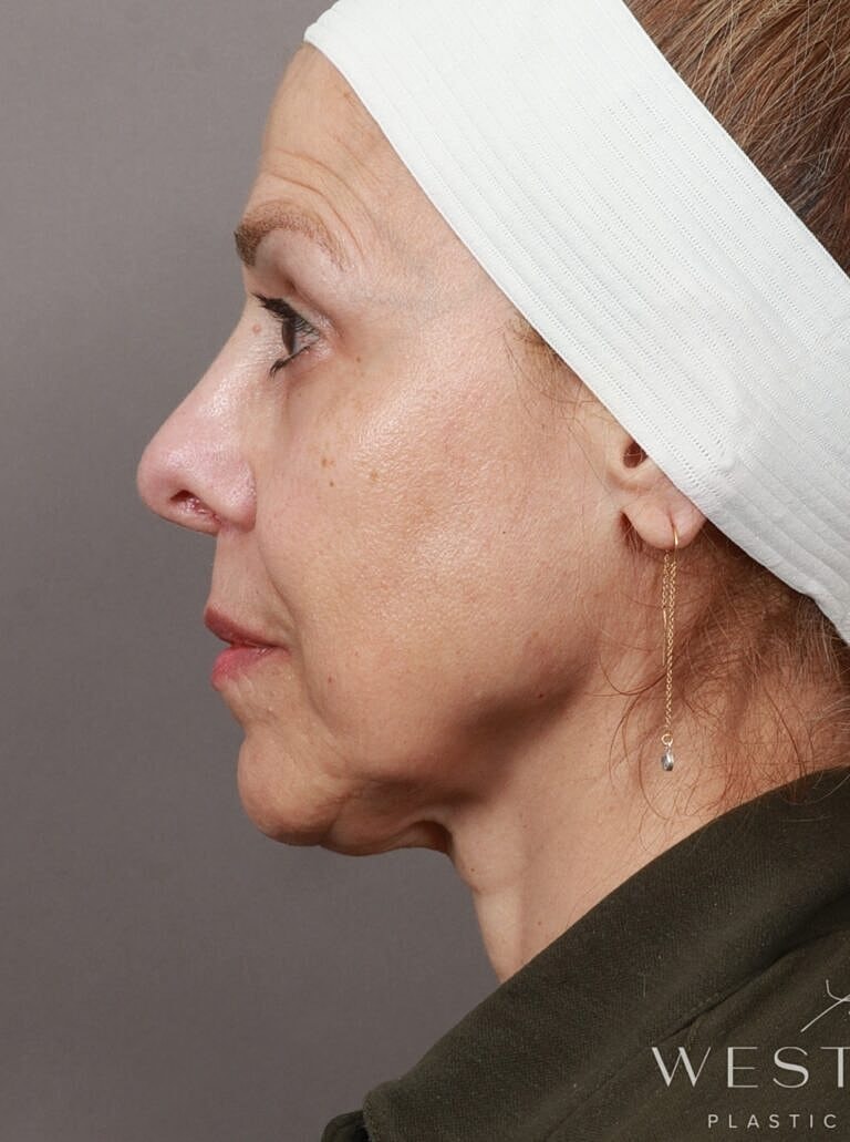 Brow Lift Before & After