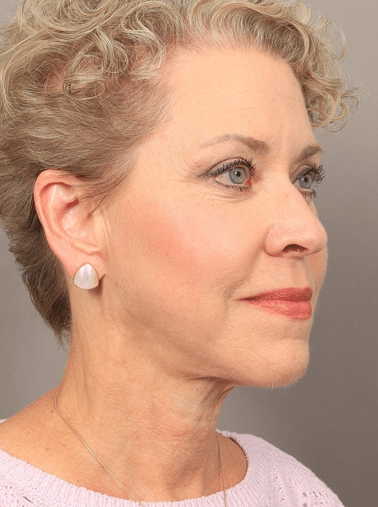 Brow Lift Before & After