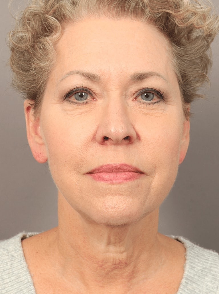 Brow Lift Before & After