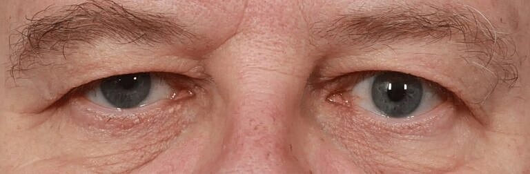 Brow Lift Before & After