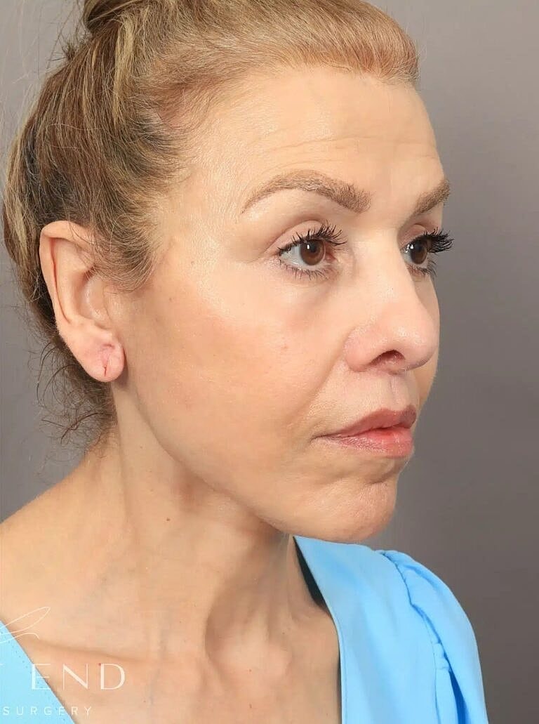 Brow Lift Before & After