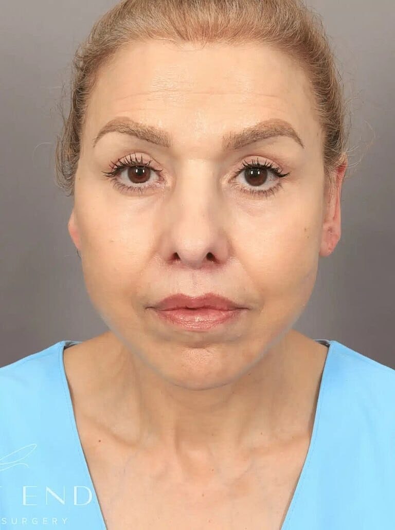 Brow Lift Before & After