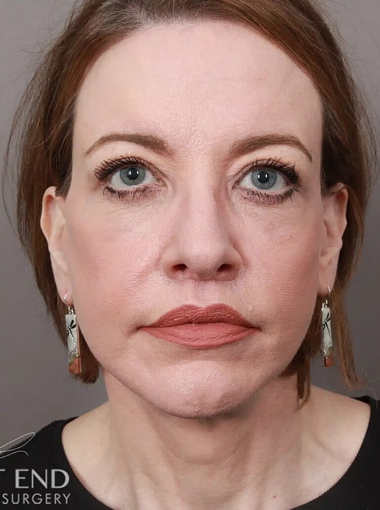 Brow Lift Before & After