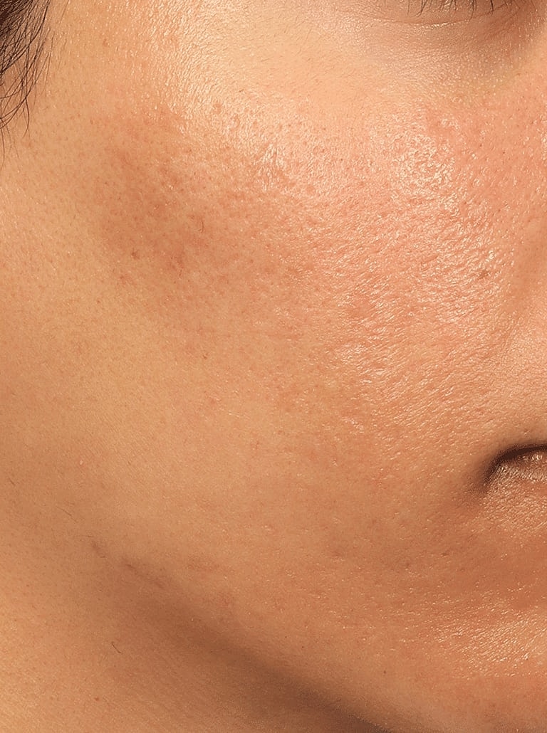 Chemical Peels Before & After