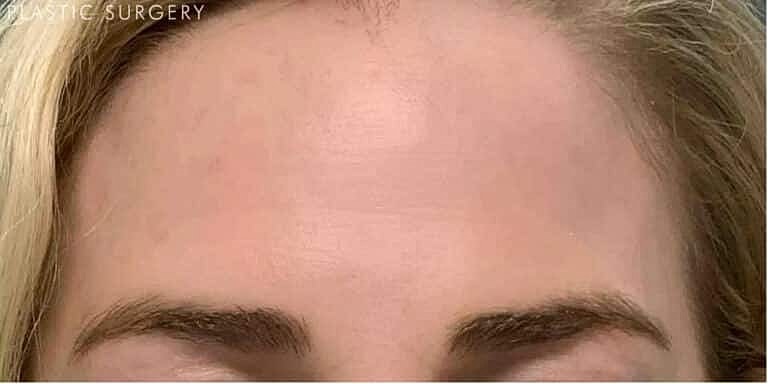 Chemical Peels Before & After