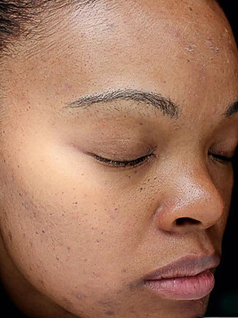 Chemical Peels Before & After