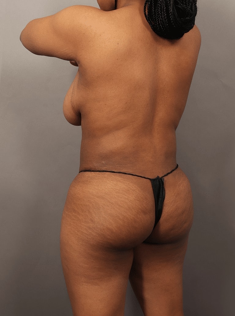 Cosmetic Fat Transfer Before & After