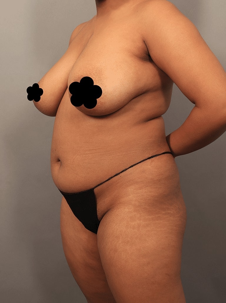 Cosmetic Fat Transfer Before & After