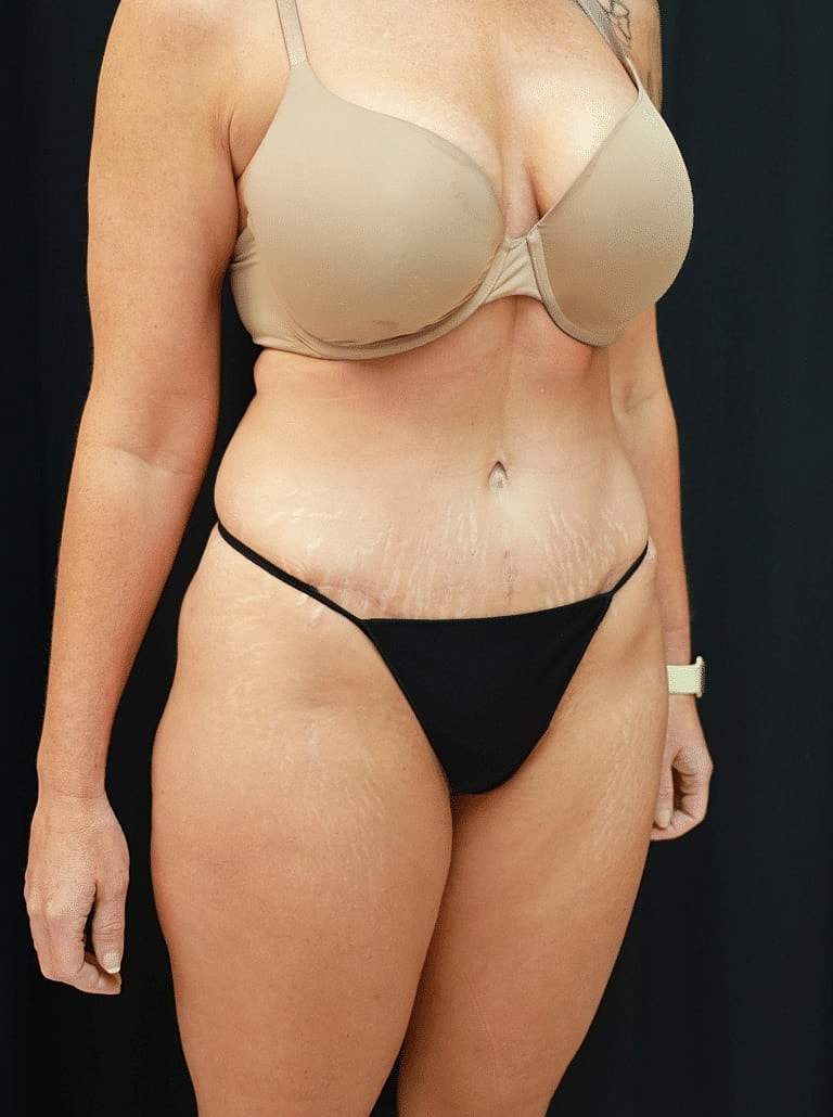 Cosmetic Fat Transfer Before & After
