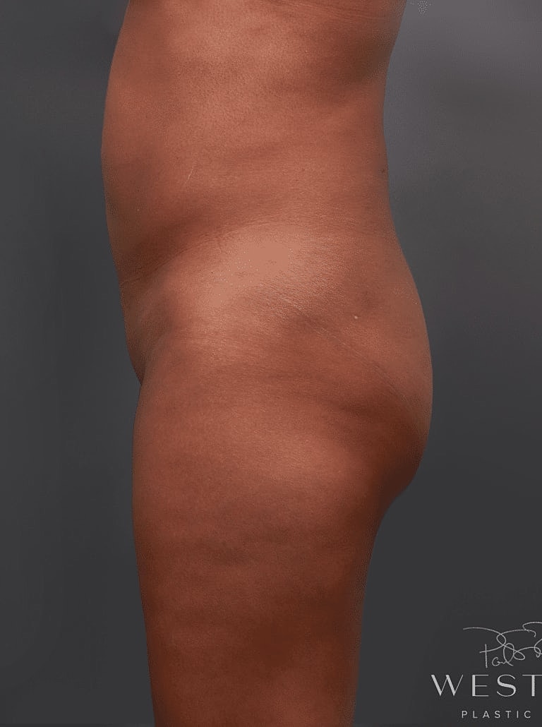 Cosmetic Fat Transfer Before & After