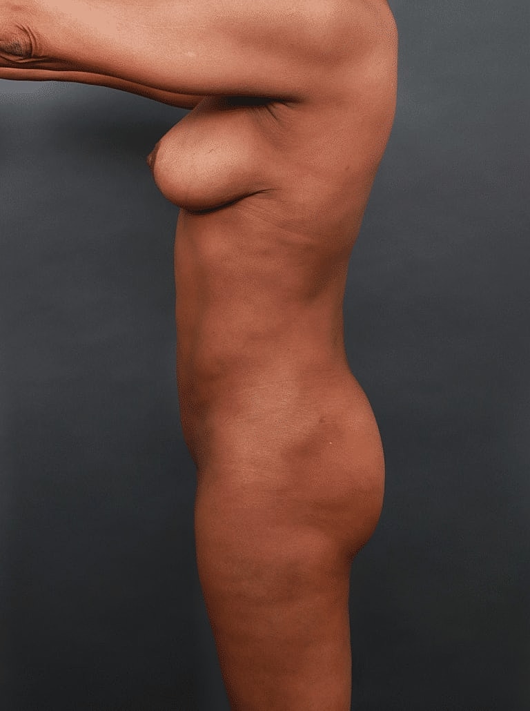 Cosmetic Fat Transfer Before & After