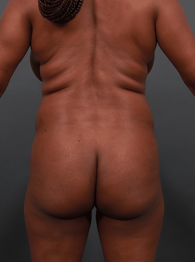 Cosmetic Fat Transfer Before & After