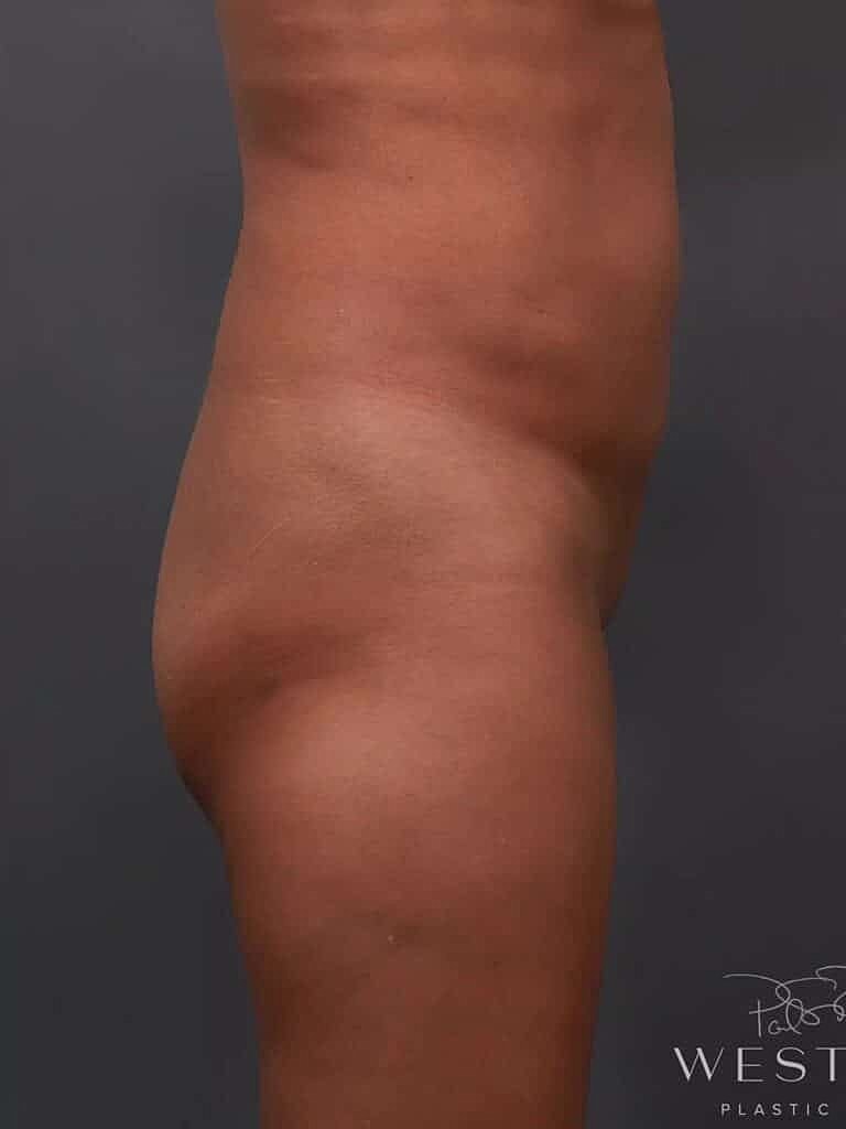 Cosmetic Fat Transfer Before & After
