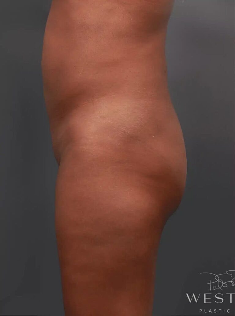 Cosmetic Fat Transfer Before & After