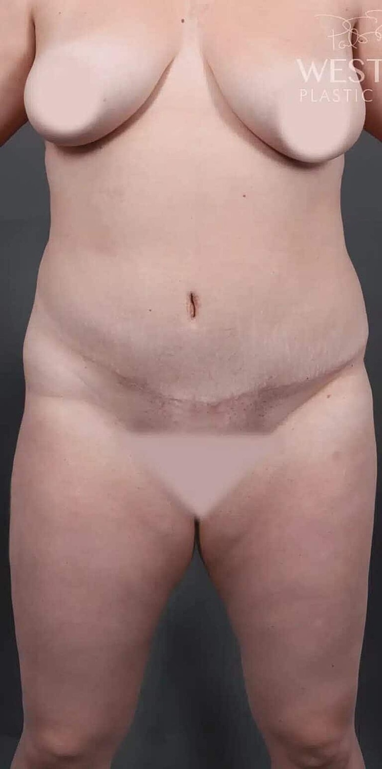 Cosmetic Fat Transfer Before & After