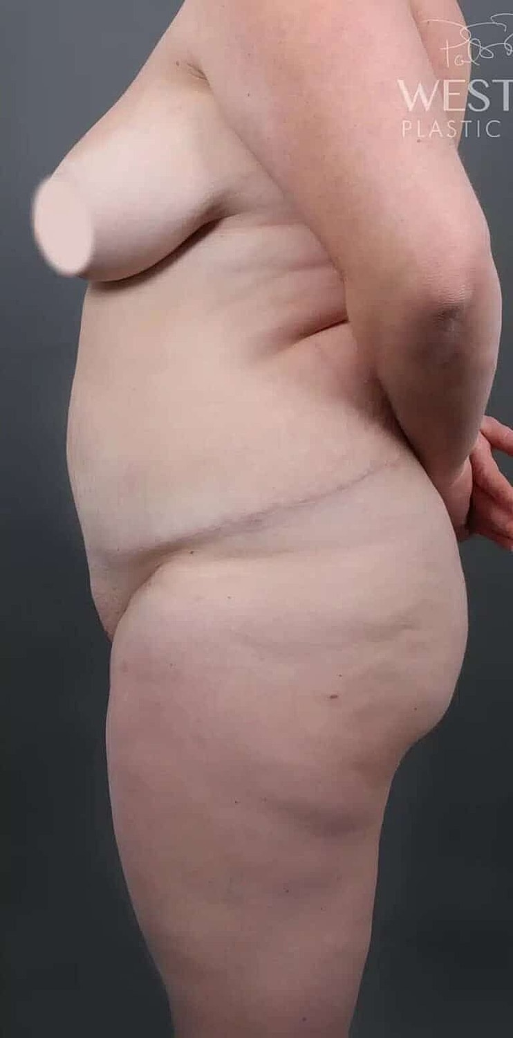 Cosmetic Fat Transfer Before & After