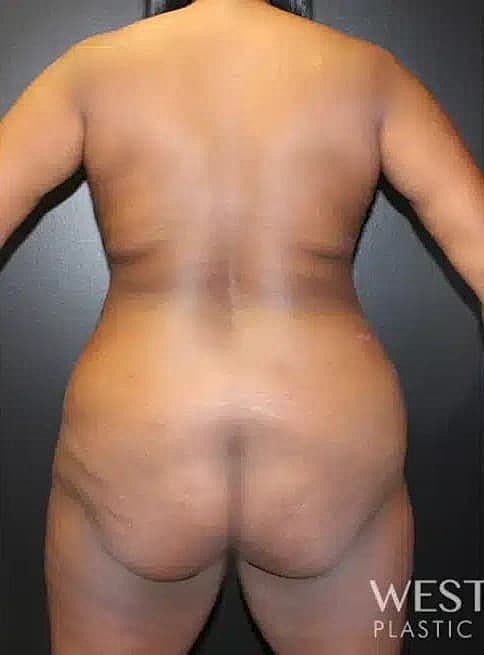 Cosmetic Fat Transfer Before & After