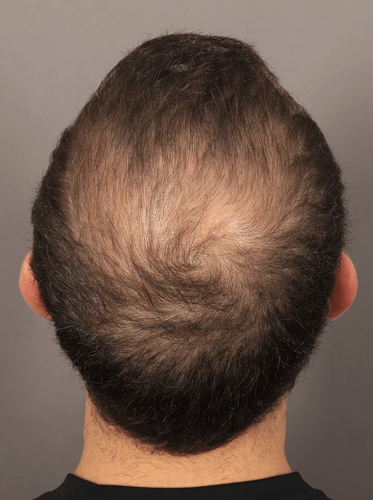 Hair Restoration Before & After