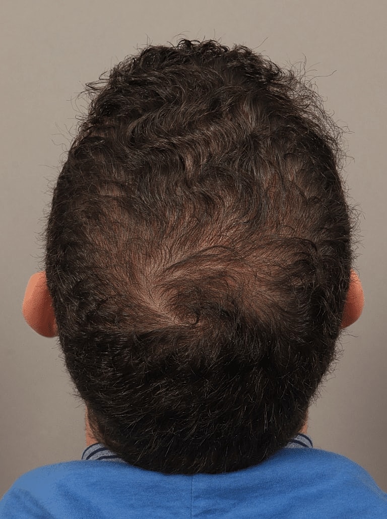 Hair Restoration Before & After