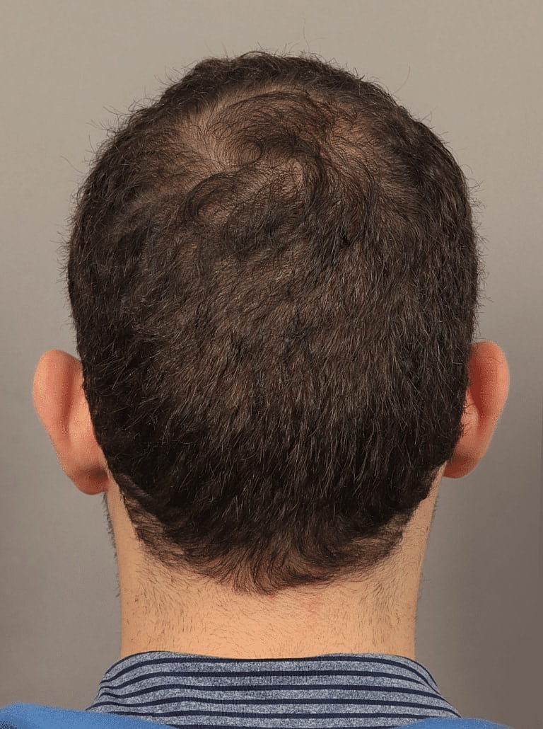 Hair Restoration Before & After