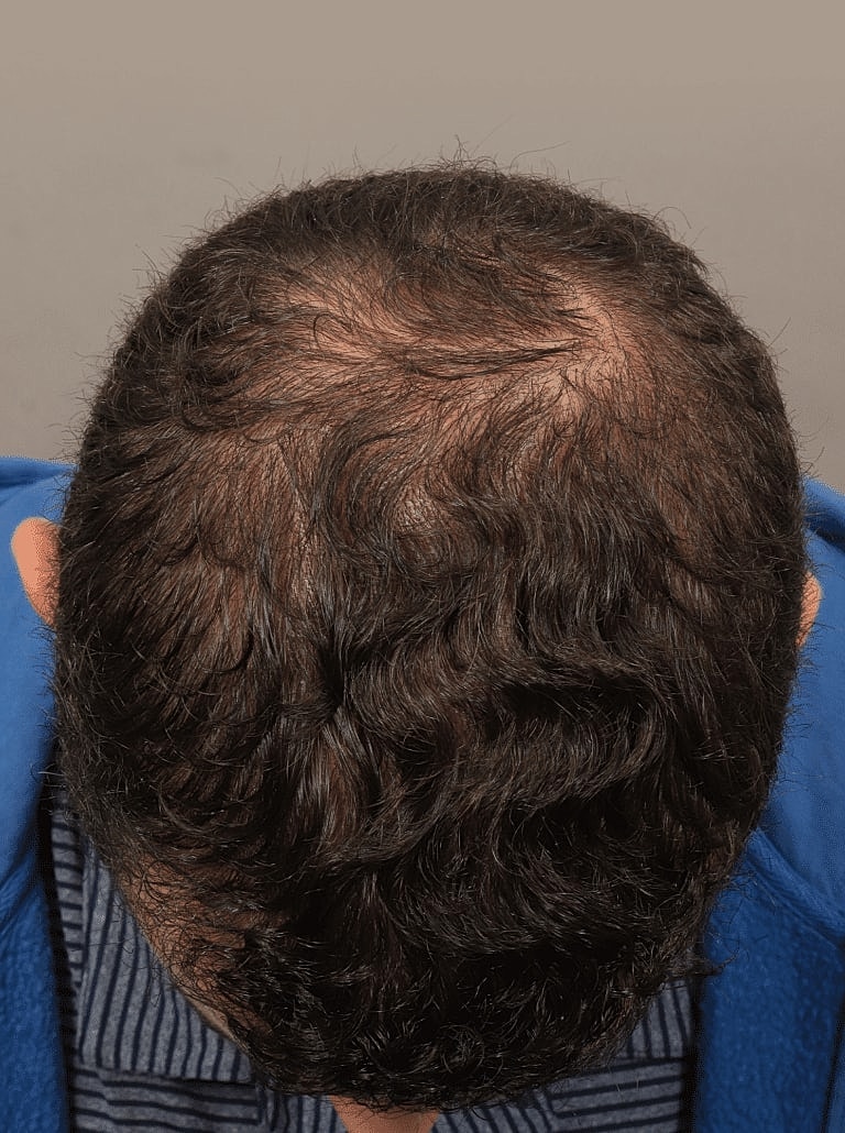 Hair Restoration Before & After