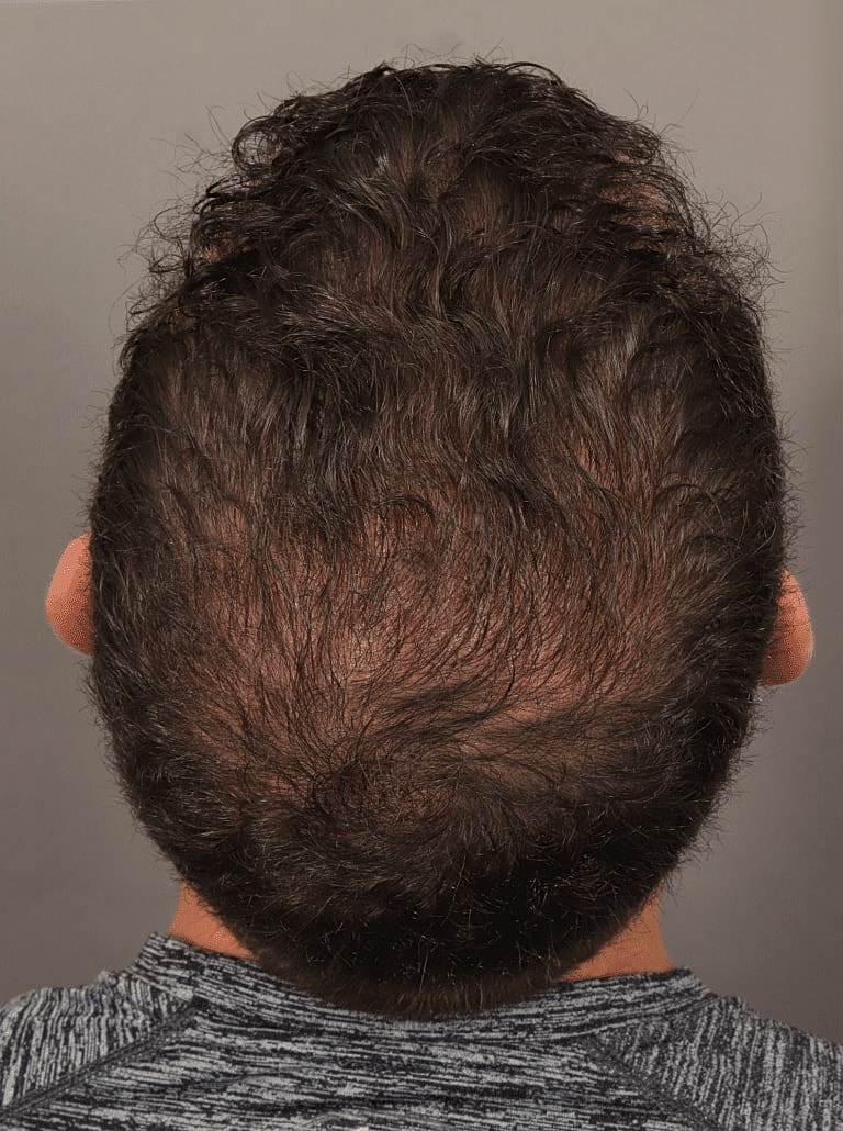 Hair Restoration Before & After