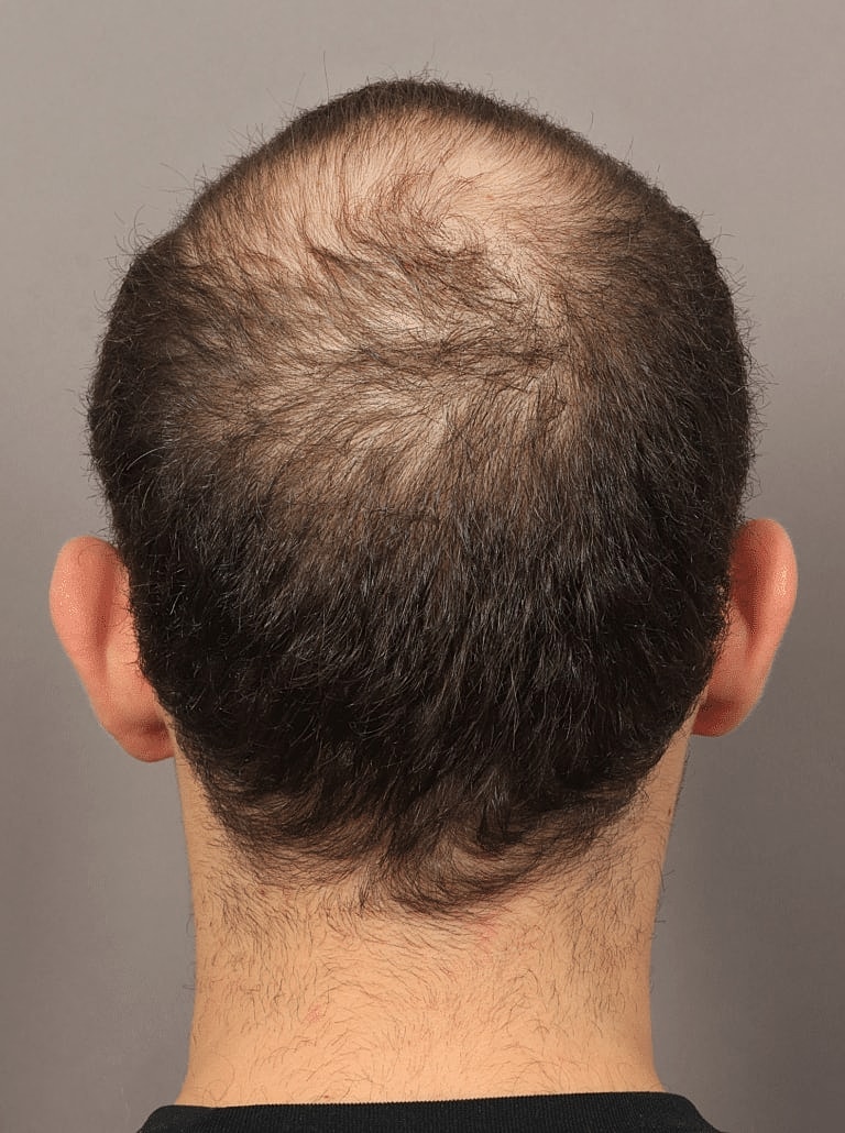 Hair Restoration Before & After