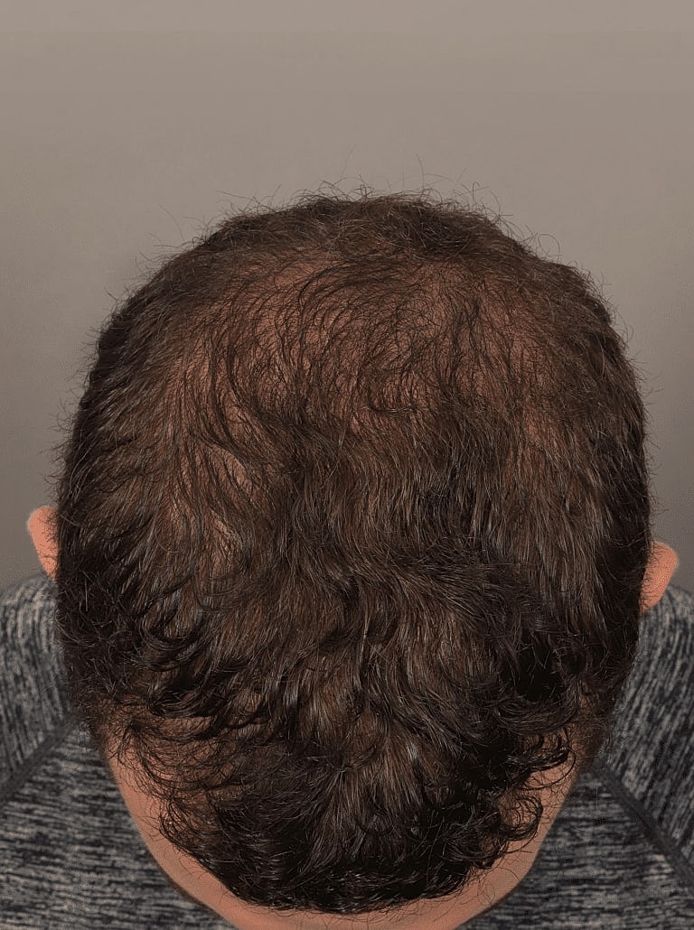 Hair Restoration Before & After