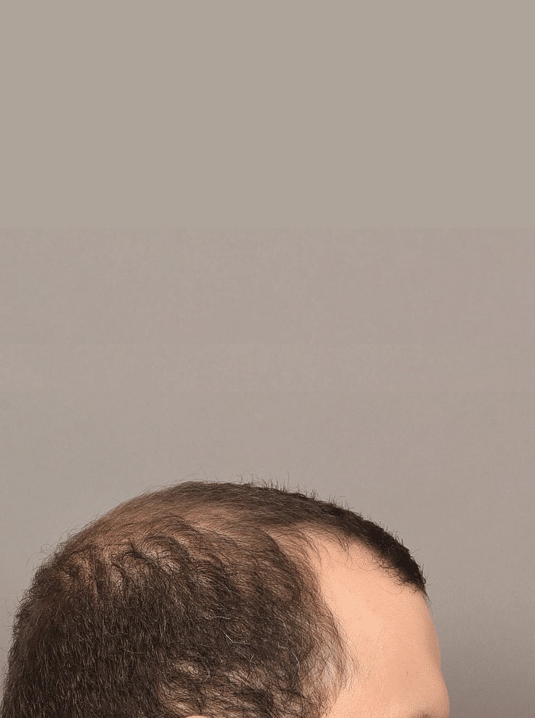 Hair Restoration Before & After