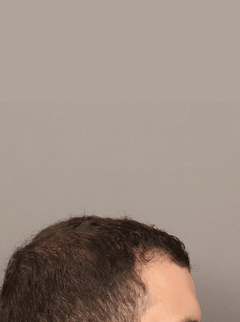 Hair Restoration Before & After